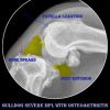 bulldog patella luxation MPL with joint effusion and bone spears