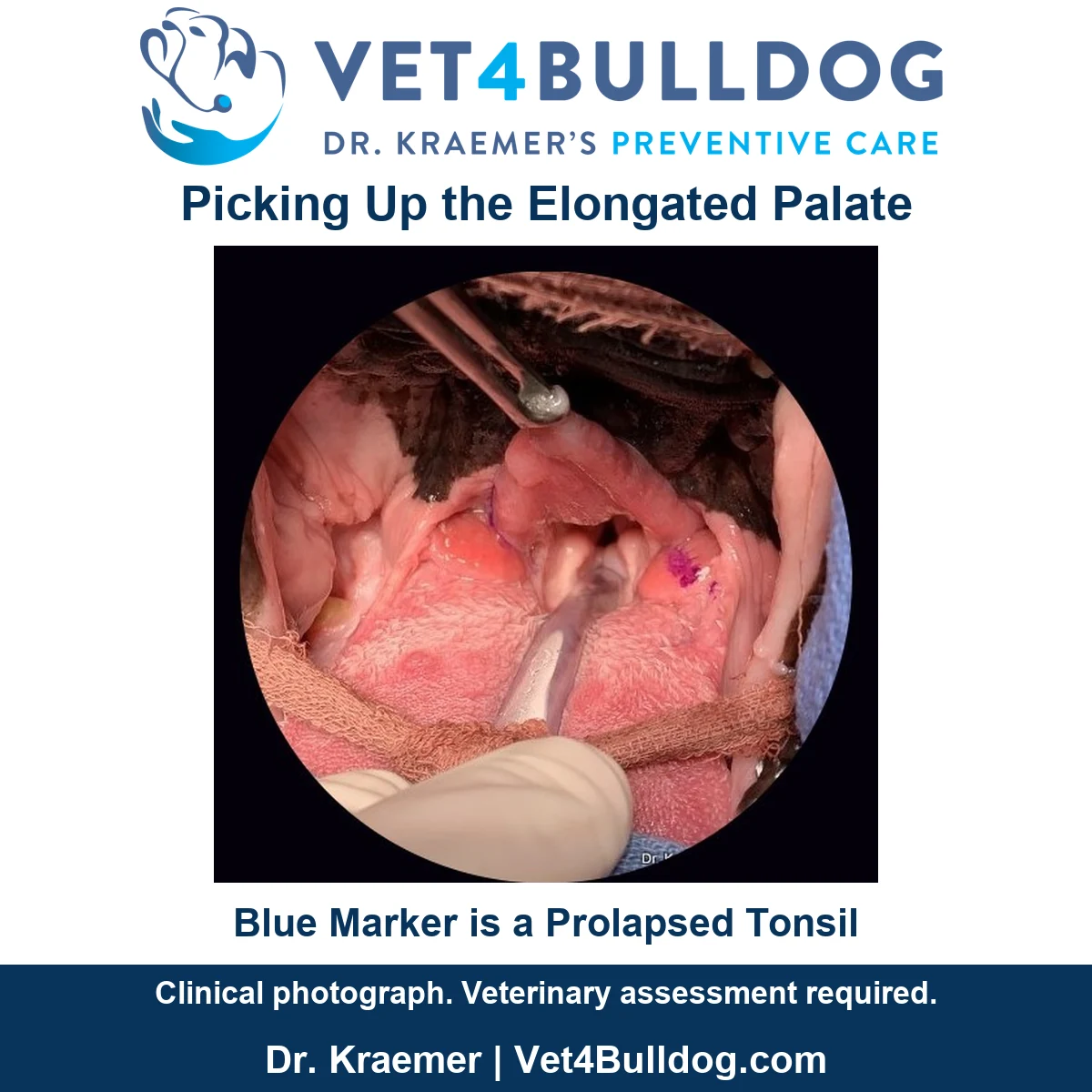 Original Bulldog intraoral photograph showing the elongated soft palate held by forceps and the original tonsil marker.
