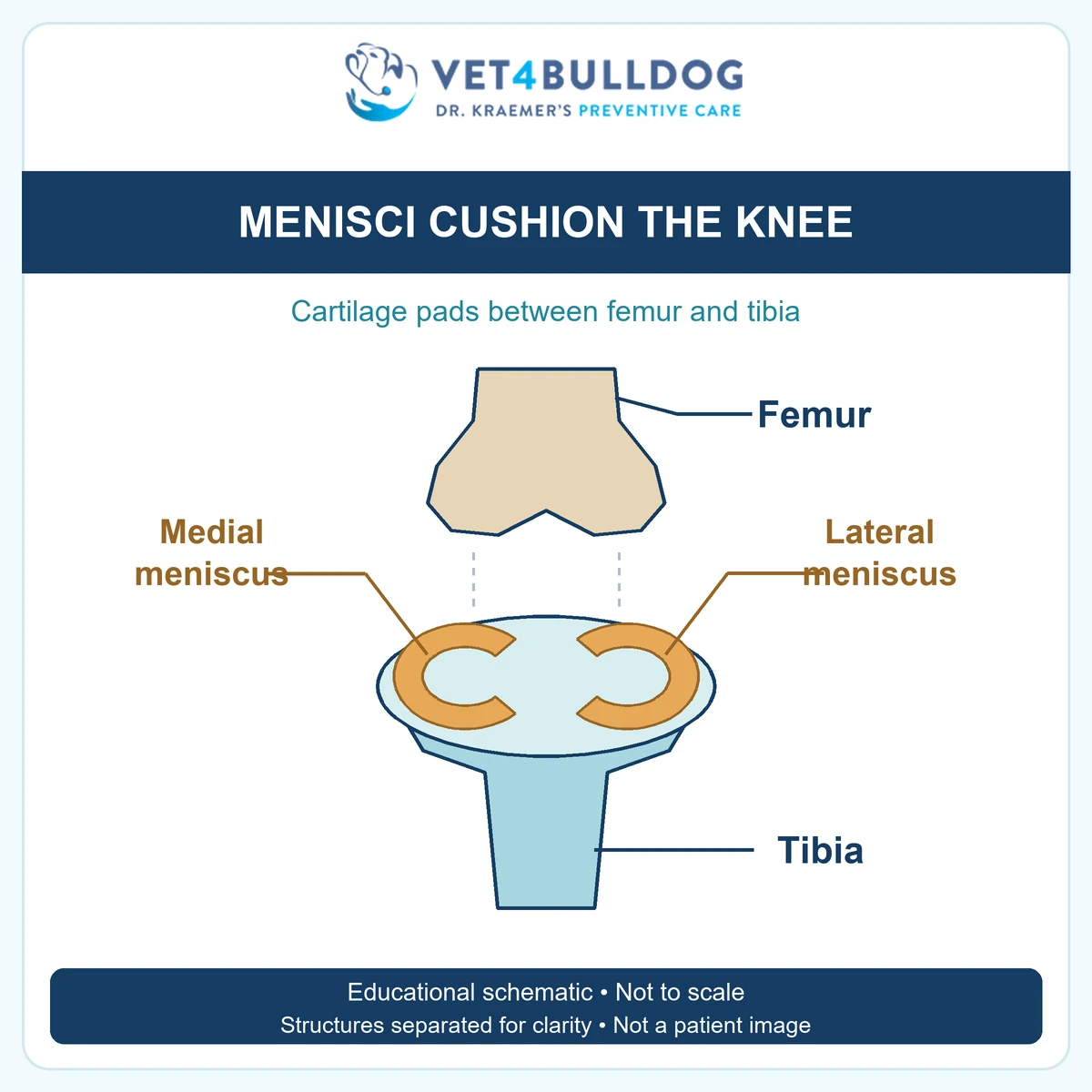 Educational schematic showing medial and lateral meniscal cartilage pads between the femur and tibia; structures separated for clarity.